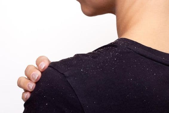 Jeune femme en chemise noire tenant son épaule, traces de pellicules sur la chemise.