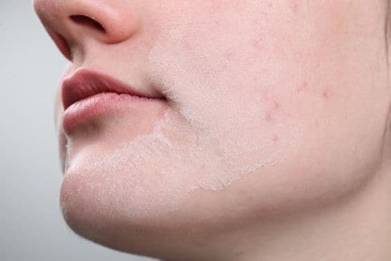 Femme avec la peau sèche sur le visage contre un fond clair.