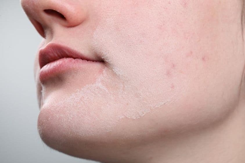 Femme avec la peau sèche sur le visage contre un fond clair.